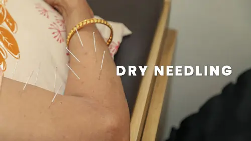 The Painex Dryneedling Therapy