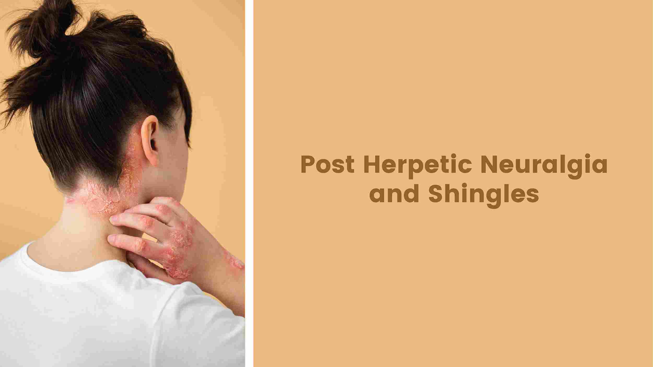 The Painex Post Herpetic Neuralgia and Shingles